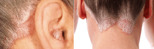 Revolutionary discovery! Say “NO” to psoriasis now!